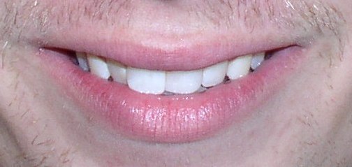 Misaligned Teeth Orthodontic Braces North Phoenix - Before