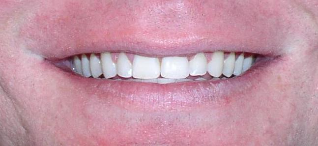Misaligned Teeth Orthodontic Dentist Braces - After