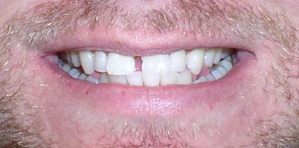 Misaligned Teeth Orthodontic Dentist Braces - Before