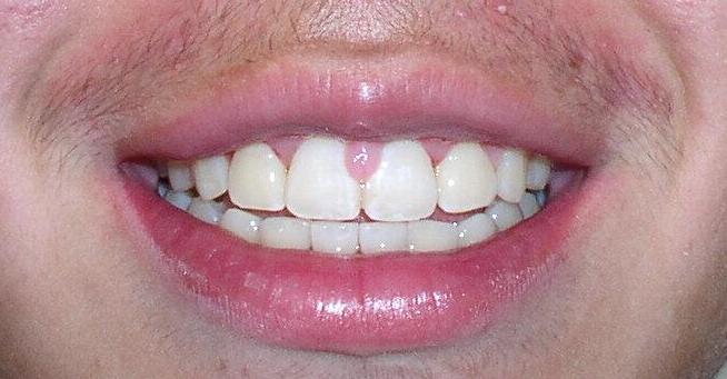 After Orthodontic Treatment