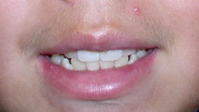 Before Orthodontic Treatment