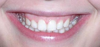 Orthodontic dental treatments by Dr. Greg Ceyhan corrected this patients smile, as can be seen here in the after picture.