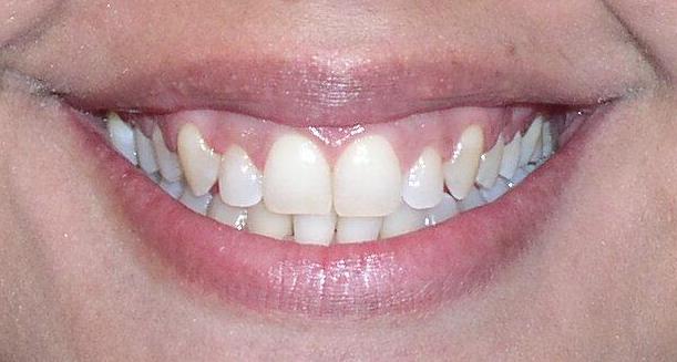 After Braces And Enamel Shaping Treatment