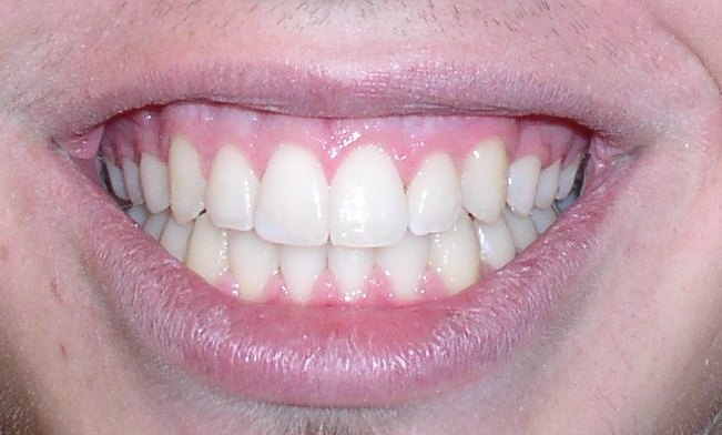 After Enamel Shaping And Orthodontic Treatment