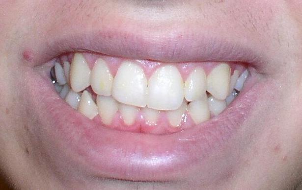 Before Enamel Shaping And Orthodontic Treatment