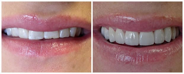 Before And After Dental Veneers