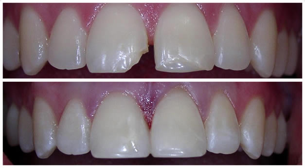 Before And After Dental Bonding On Cracked Tooth