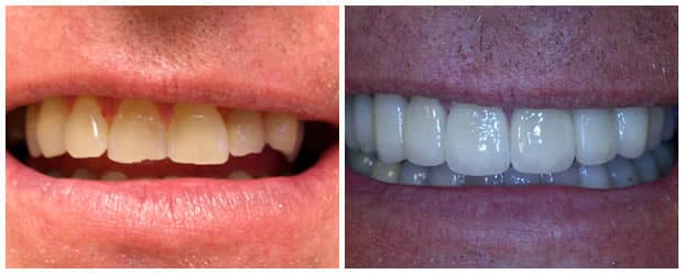 Before And After Dental Veneers