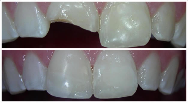 Before And After Dental Bonding On Broken Tooth