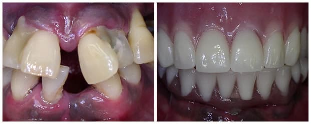 Before And After Dental Treatment