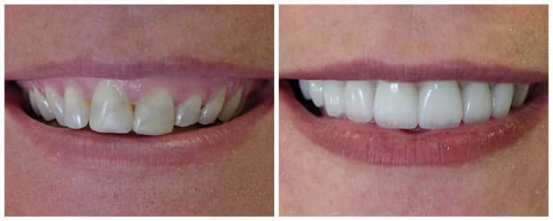 Before And After Teeth Veneers