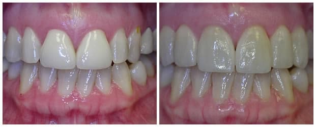Before And After Teeth Reshaping