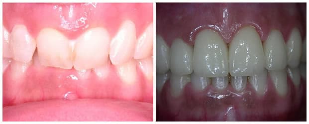 Before And After Dental Braces