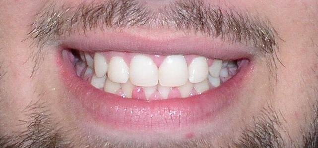 After Orthodontic Treatment