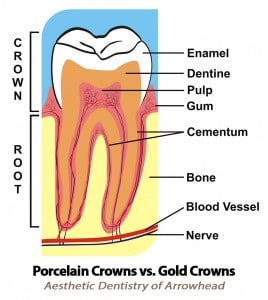 Cosmetic Dental Porcelain Crowns vs. Gold Crowns in Peoria