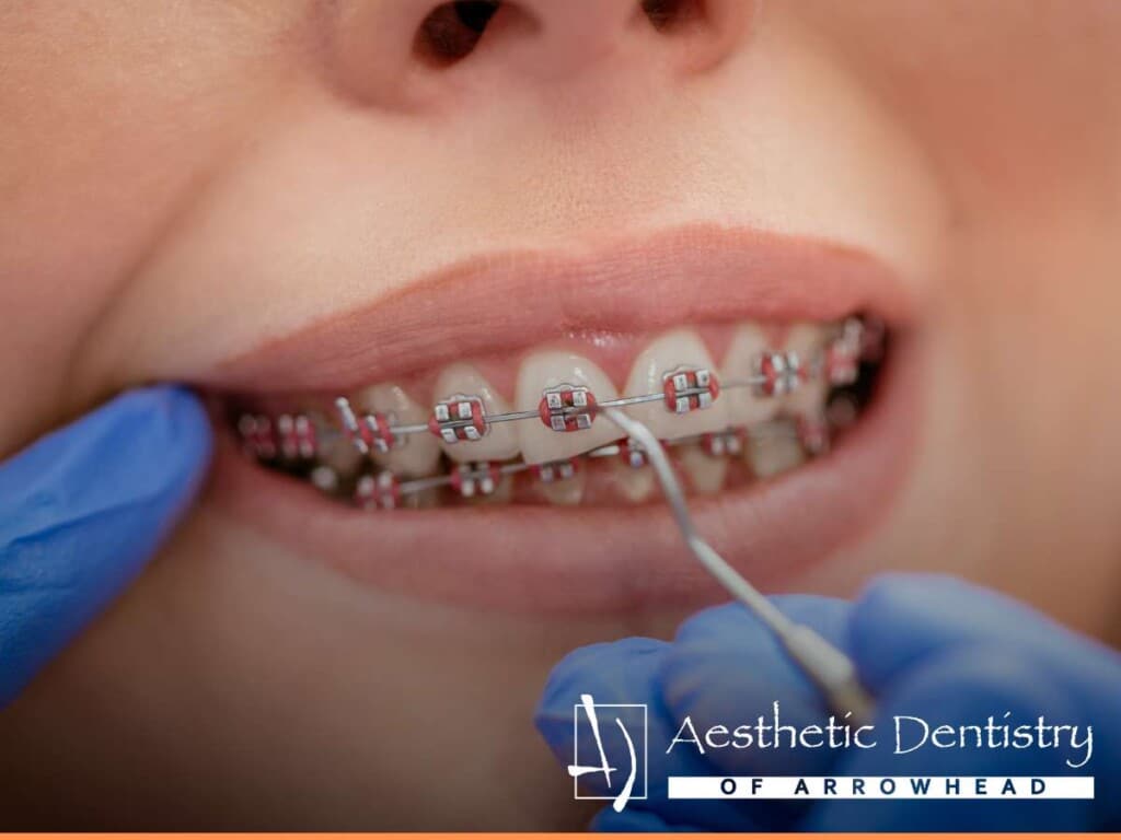 Close-up of a patient receiving adjustment on their braces at Aesthetic Dentistry of Arrowhead