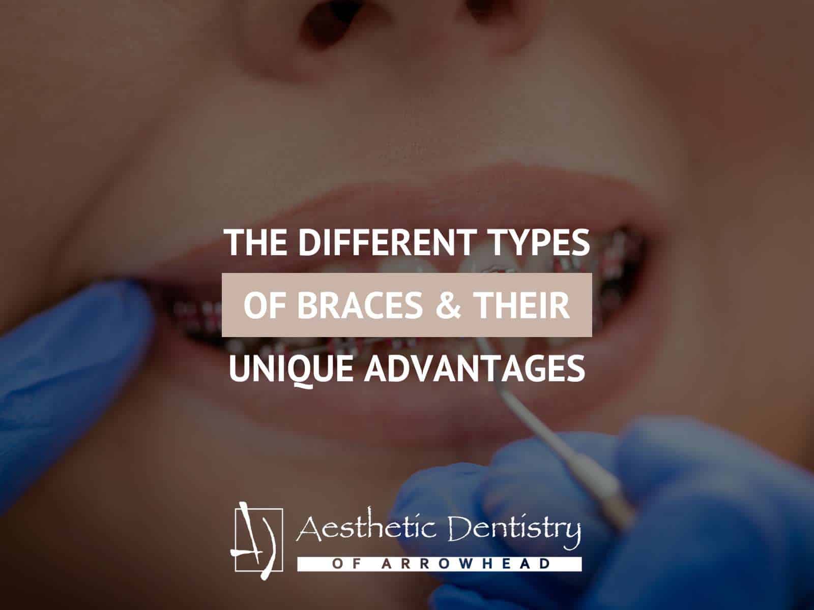 The Different Types Of Braces & Their Unique Advantages