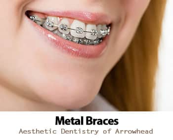 Options for Glendale Metal Braces