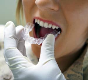 Close-up of dentist's hand placing plastic braces