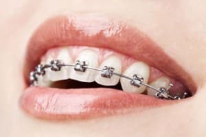 I Got Phoenix Braces- Now What?