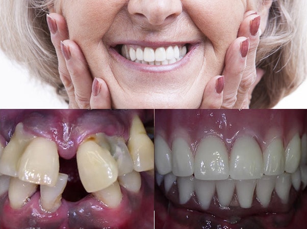 Get a full set of Teeth in a Day™ with a dental implant prosthesis in Glendale, AZ