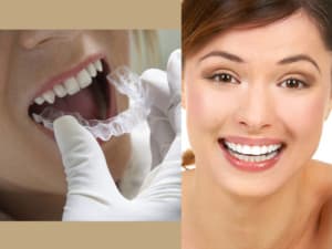 Home Whitening Kits for teeth in Glendale