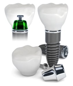 How Listening to Your North Phoenix Dentist Can Help You Spot the Early Signs of Dental Implant Problems