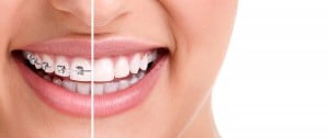Common Reasons Your Peoria Braces are Falling off