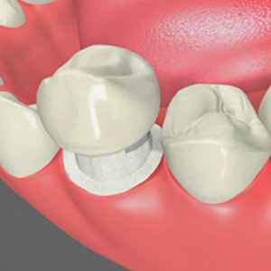 What You Should Know About Tooth Decay Under Your Glendale Dental Implant