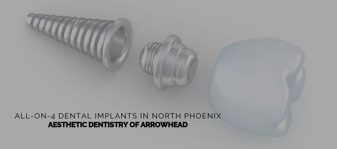 All on 4 dental implants in North Phoenix