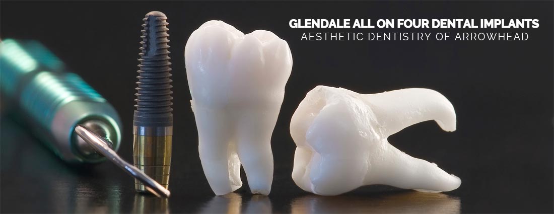 Glendale All-on-4 Dental Implants By Aesthetic Dentistry of Arrowhead