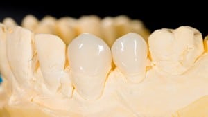 veneers aesthetic dentistry