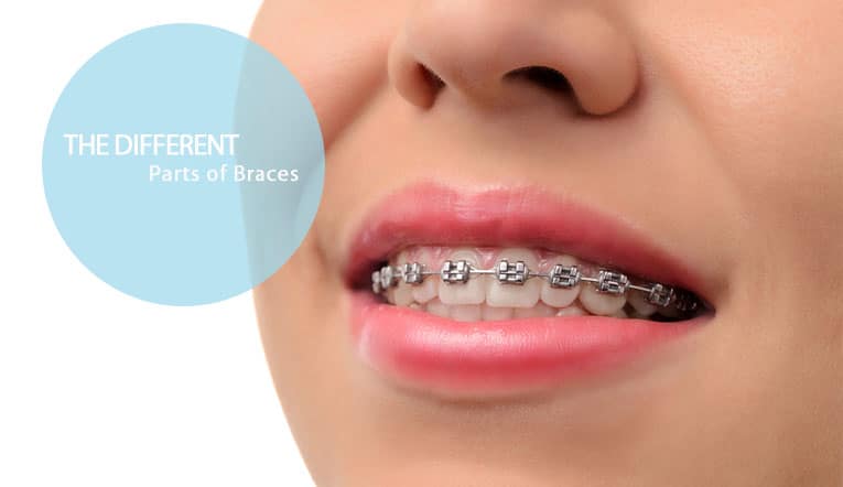different parts braces