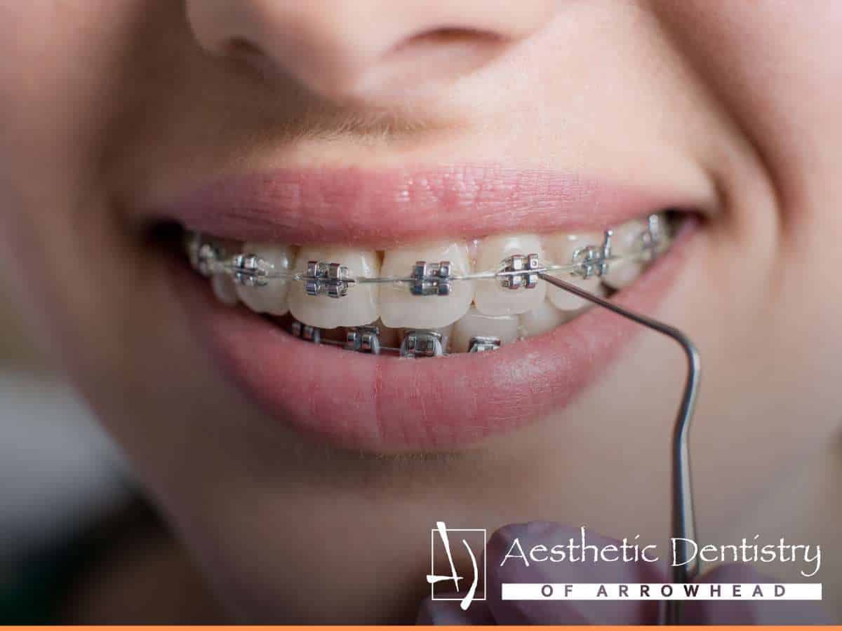 A close-up of a person getting their braces adjusted.