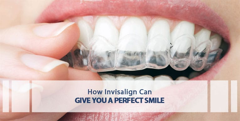 how invisalign can give you a perfect smile