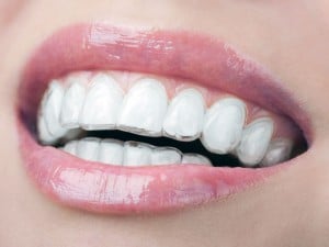 smiling mouth with invisalign on teeth