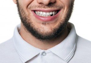 man smiling with missing tooth