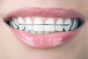 woman smiling with retainer on teeth