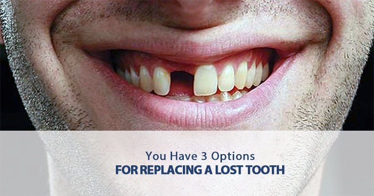 you have 3 options for replacing a lost tooth