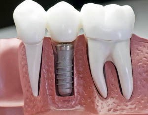 how to care for dental implants