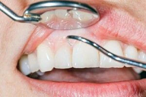 the anatomy of dark triangle between teeth