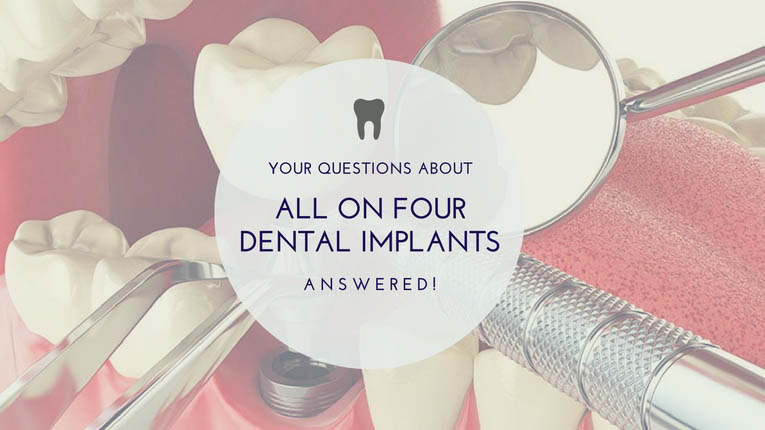 your questions about all on four dental implants answered