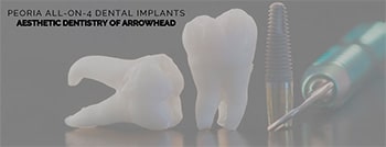 All-on-4 Dental Implants for Peoria Residents