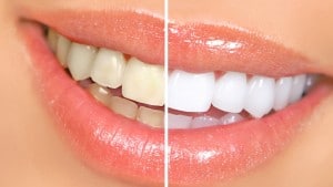 teeth whitening to make you look older