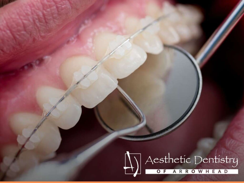 Close-up of braces being adjusted at Aesthetic Dentistry of Arrowhead