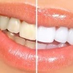 Teeth whitening are a great way to have a nice smile