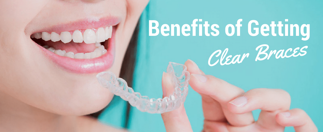 Benefits of getting clear braces
