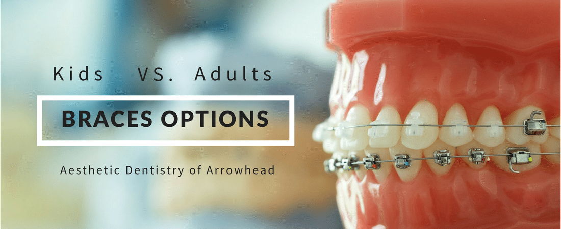 Braces options for kids VS braces for adults