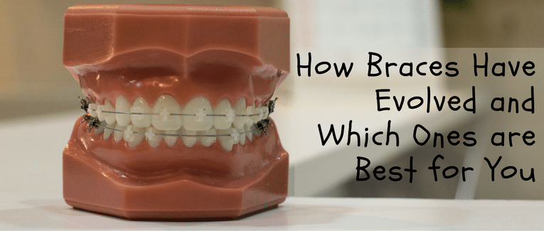 How Braces Have Evolved and Which Ones are Best for You