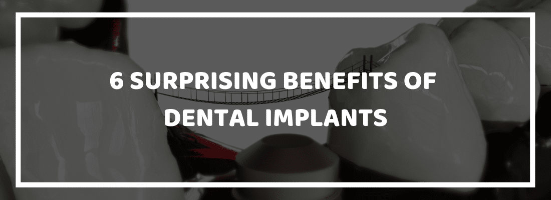 Surprising Benefits of Dental Implants